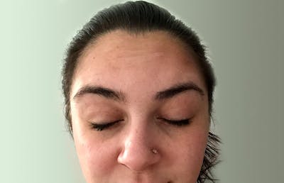 Botox Before & After Gallery - Patient 112338675 - Image 2