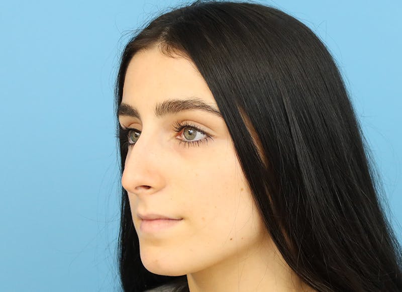 Rhinoplasty Before & After Gallery - Patient 112338679 - Image 3