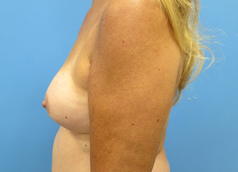 Augmentation Before & After Gallery - Patient 112338676 - Image 1