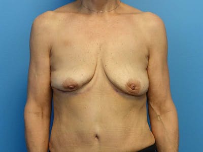 Implant Removal Before & After Gallery - Patient 112338684 - Image 6