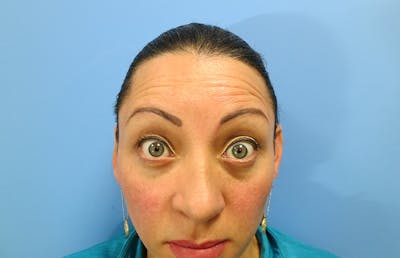 Botox Before & After Gallery - Patient 112338678 - Image 1