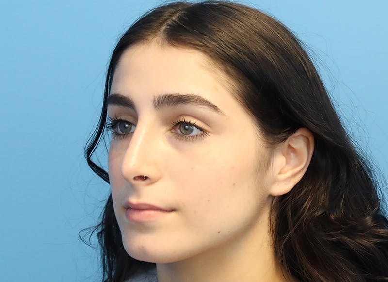 Rhinoplasty Before & After Gallery - Patient 112338679 - Image 4