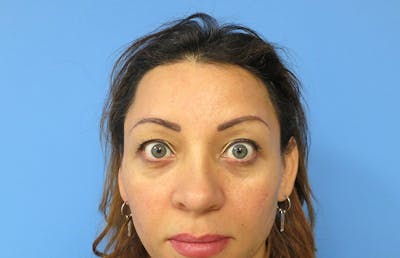 Botox Before & After Gallery - Patient 112338678 - Image 2