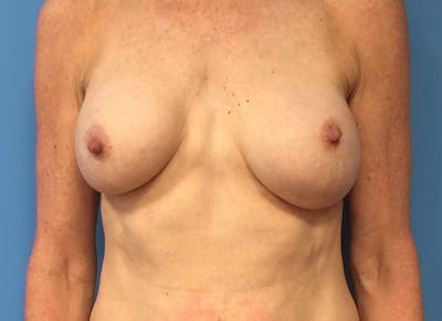Augmentation Before & After Gallery - Patient 112338686 - Image 5