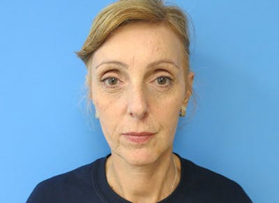 Fillers Before & After Gallery - Patient 112338687 - Image 6