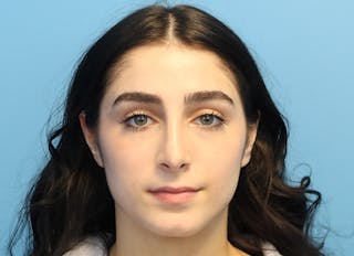 Rhinoplasty Before & After Gallery - Patient 112338679 - Image 6