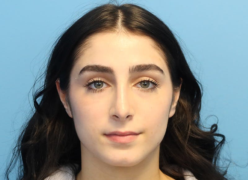 Rhinoplasty Before & After Gallery - Patient 112338679 - Image 6