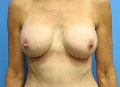 Augmentation Before & After Gallery - Patient 112338686 - Image 6