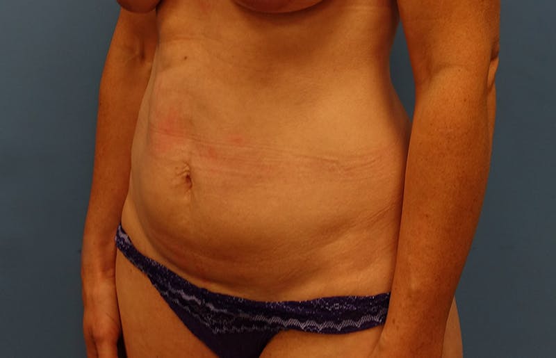 Abdominoplasty Before & After Gallery - Patient 112338682 - Image 3