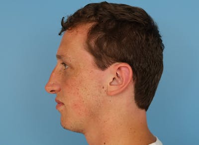 Rhinoplasty Before & After Gallery - Patient 112338692 - Image 1