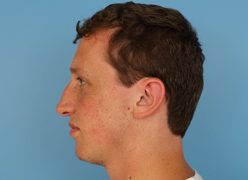 Rhinoplasty Before & After Gallery - Patient 112338692 - Image 1