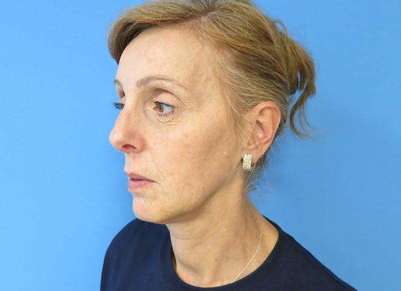 Fillers Before & After Gallery - Patient 112338687 - Image 4