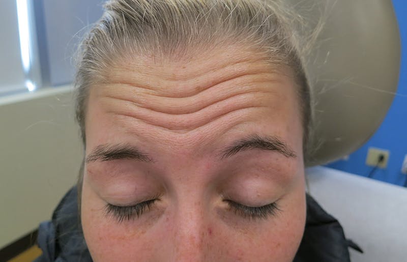 Botox Before & After Gallery - Patient 112338683 - Image 1