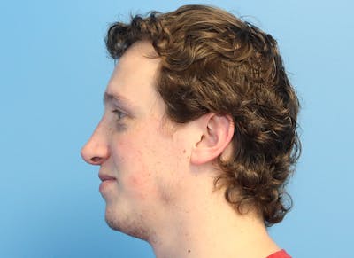 Rhinoplasty Before & After Gallery - Patient 112338692 - Image 2