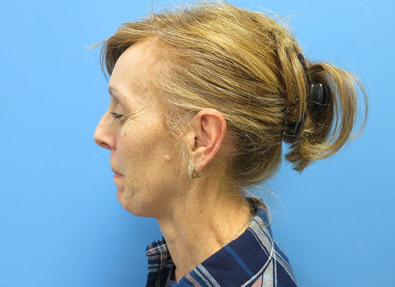 Fillers Before & After Gallery - Patient 112338687 - Image 1