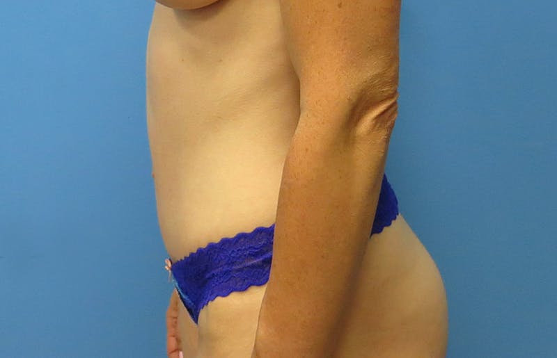 Abdominoplasty Before & After Gallery - Patient 112338682 - Image 2