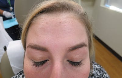 Botox Before & After Gallery - Patient 112338683 - Image 2