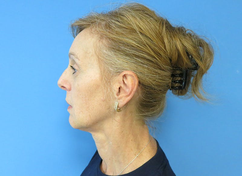 Fillers Before & After Gallery - Patient 112338687 - Image 2