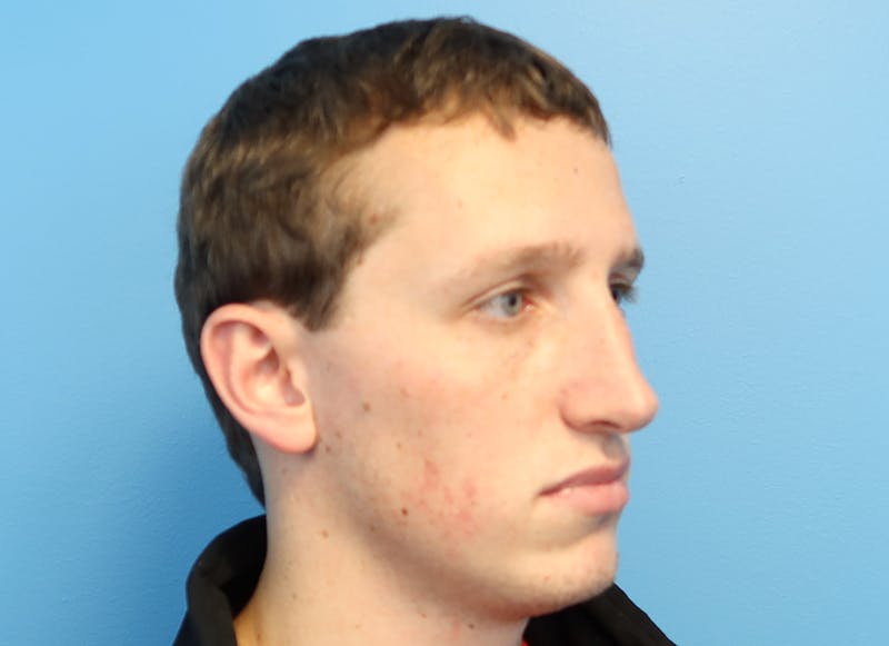 Rhinoplasty Before & After Gallery - Patient 112338692 - Image 7