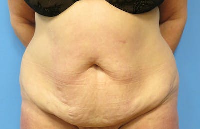 Abdominoplasty Before & After Gallery - Patient 112338695 - Image 5
