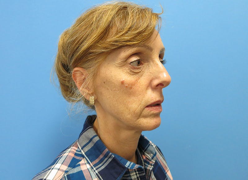 Fillers Before & After Gallery - Patient 112338687 - Image 7