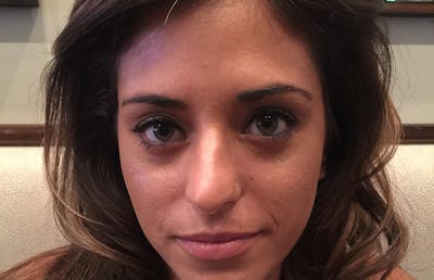 Botox Before & After Gallery - Patient 112338685 - Image 2