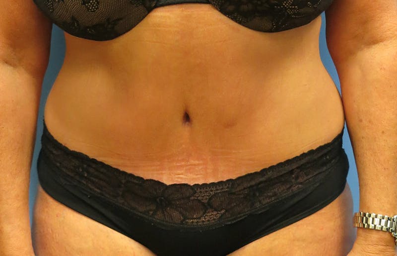 Abdominoplasty Before & After Gallery - Patient 112338695 - Image 6