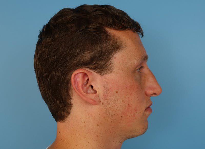 Rhinoplasty Before & After Gallery - Patient 112338692 - Image 9