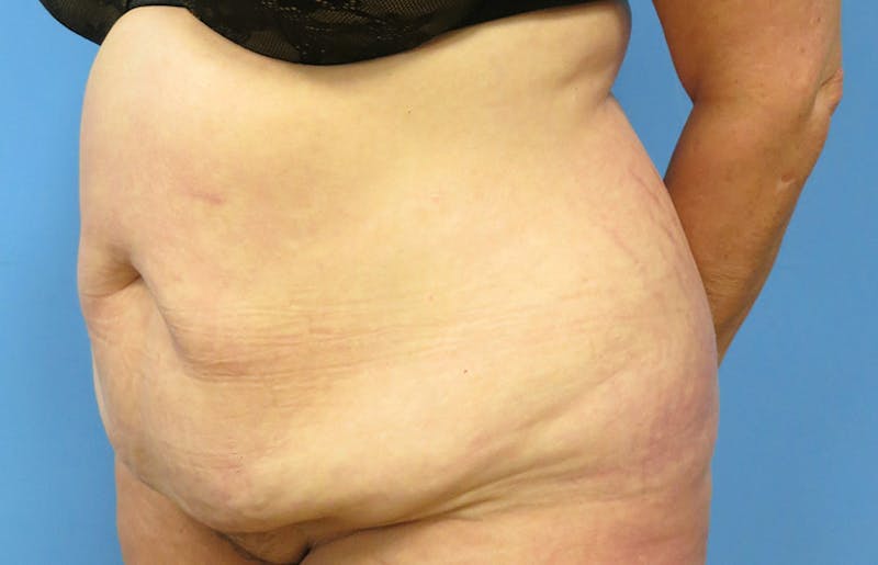 Abdominoplasty Before & After Gallery - Patient 112338695 - Image 3
