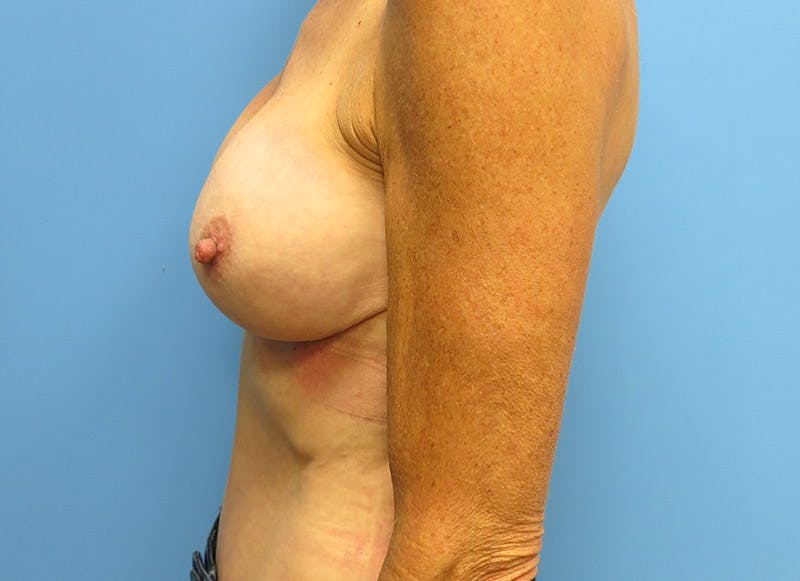 Augmentation Before & After Gallery - Patient 112338686 - Image 2