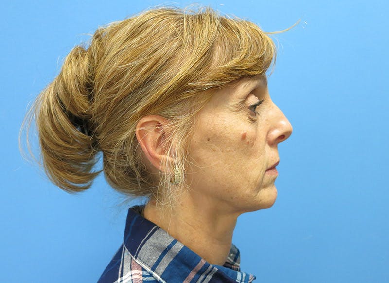 Fillers Before & After Gallery - Patient 112338687 - Image 9