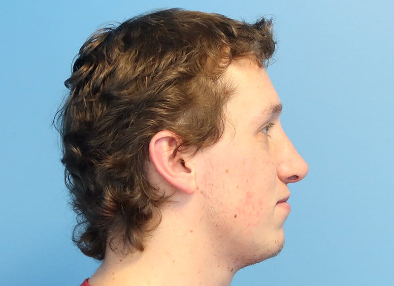 Rhinoplasty Before & After Gallery - Patient 112338692 - Image 10