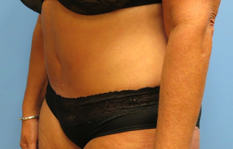 Abdominoplasty Before & After Gallery - Patient 112338695 - Image 4