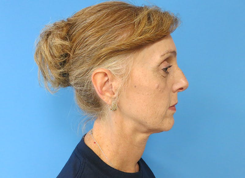 Fillers Before & After Gallery - Patient 112338687 - Image 10
