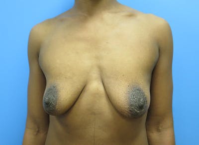 Augmentation Before & After Gallery - Patient 112338697 - Image 5