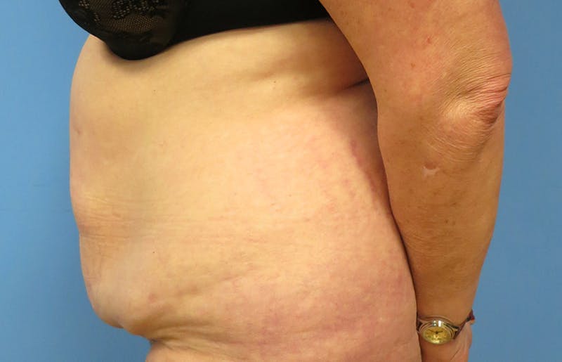 Abdominoplasty Before & After Gallery - Patient 112338695 - Image 1