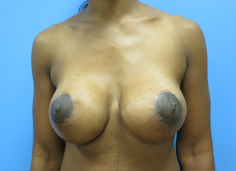 Augmentation Before & After Gallery - Patient 112338697 - Image 6