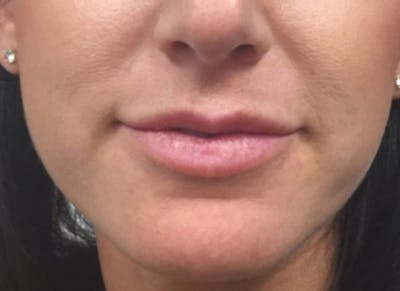 Fillers Before & After Gallery - Patient 112338688 - Image 1