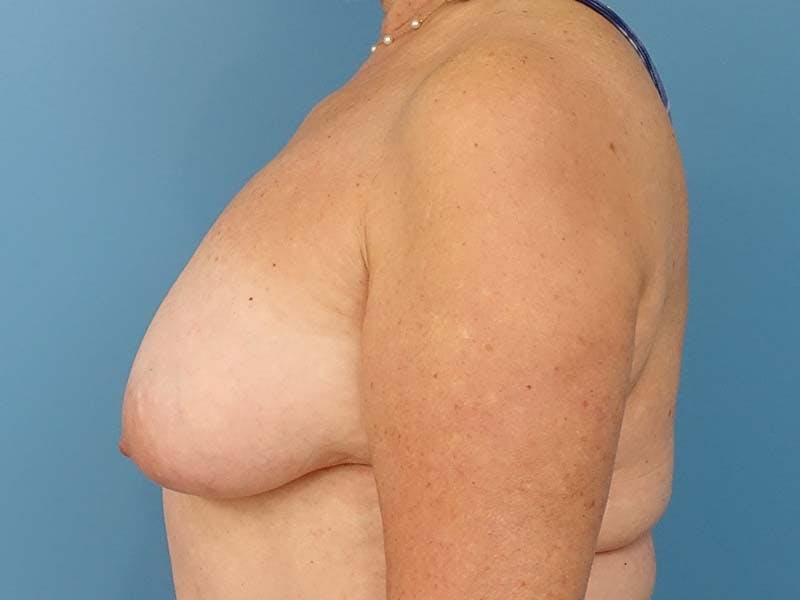 Implant Removal Before & After Gallery - Patient 112338691 - Image 1