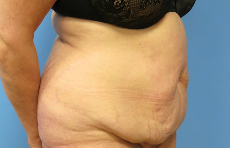 Abdominoplasty Before & After Gallery - Patient 112338695 - Image 7