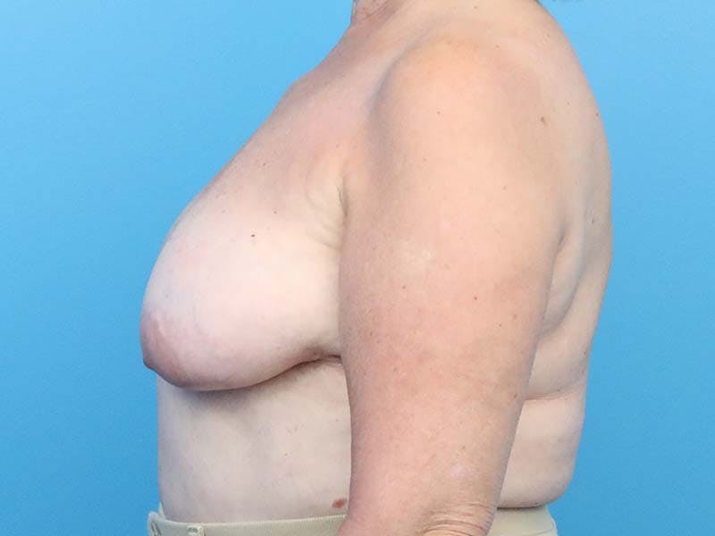 Implant Removal Before & After Gallery - Patient 112338691 - Image 2