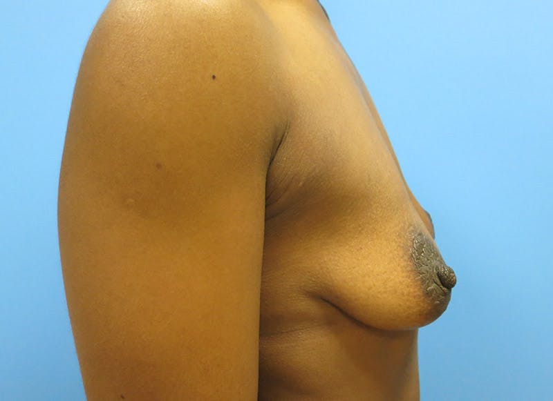 Augmentation Before & After Gallery - Patient 112338697 - Image 9