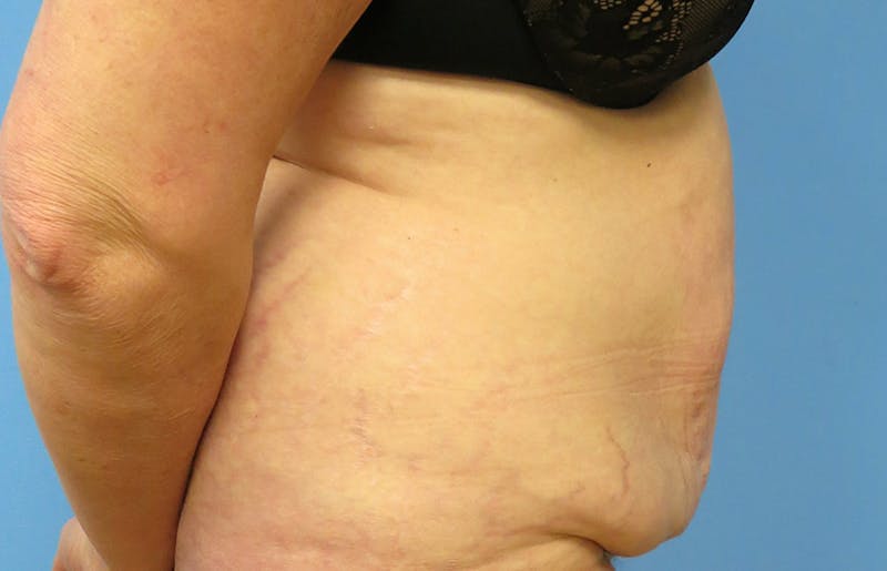 Abdominoplasty Before & After Gallery - Patient 112338695 - Image 9