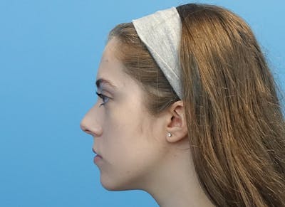 Rhinoplasty Before & After Gallery - Patient 112338704 - Image 1