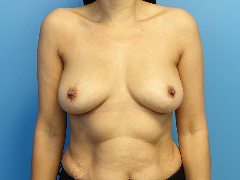 Implant Removal Before & After Gallery - Patient 112338702 - Image 6