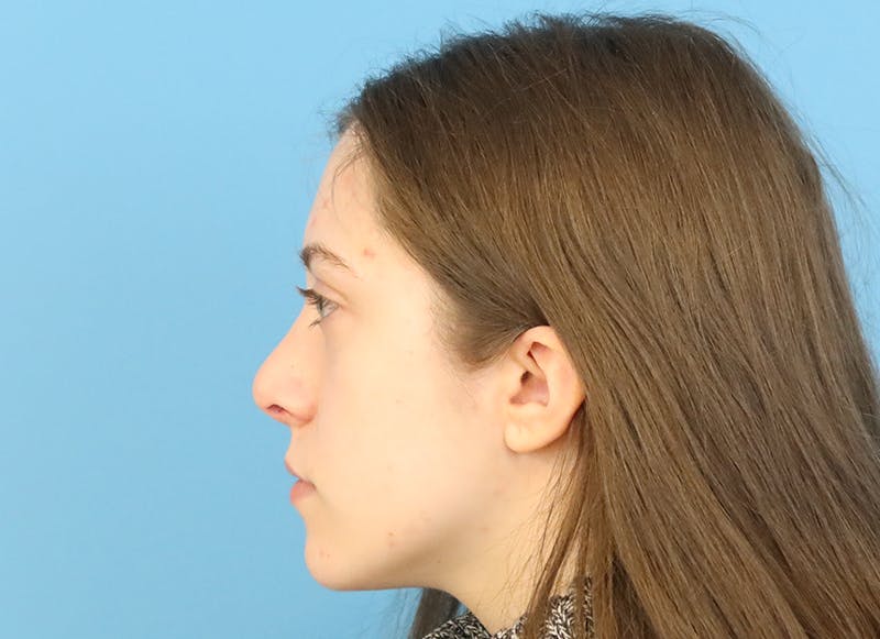 Rhinoplasty Before & After Gallery - Patient 112338704 - Image 2