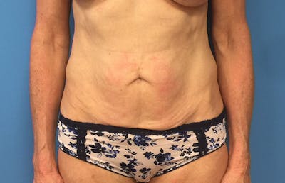 Abdominoplasty Before & After Gallery - Patient 112338707 - Image 5