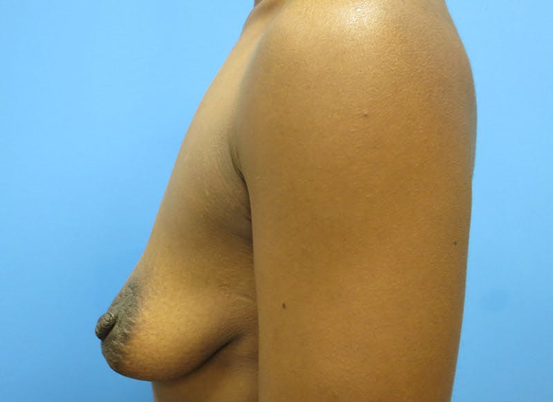 Augmentation Before & After Gallery - Patient 112338697 - Image 1