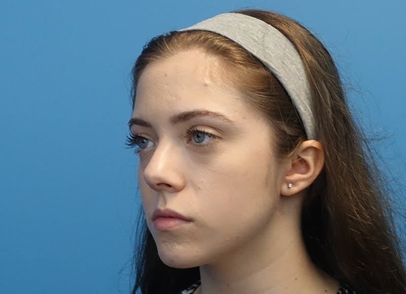 Rhinoplasty Before & After Gallery - Patient 112338704 - Image 3