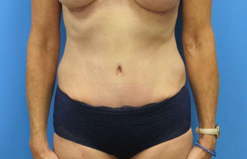 Abdominoplasty Before & After Gallery - Patient 112338707 - Image 6